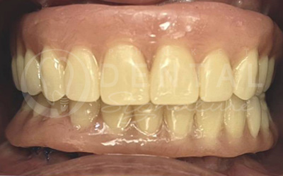 All-on-4 Upper jaw and 8 Crowns Lower jaw All-on-4 Upper jaw and 8 Crowns Lower jaw