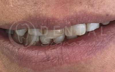 Dental Crowns, Bridge and Veneers