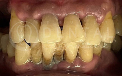 All-on-4 Upper jaw and 8 Crowns Lower jaw All-on-4 Upper jaw and 8 Crowns Lower jaw