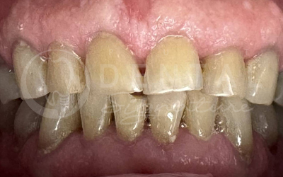 Dental Crowns and Veneers