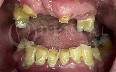 All-on-4 Upper jaw and 8 Crowns Lower jaw All-on-4 Upper jaw and 8 Crowns Lower jaw