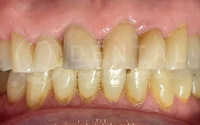 Dental Crowns, Bridge and Veneers