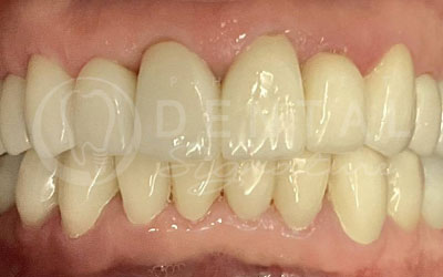 Dental Crowns, Bridge and Veneers